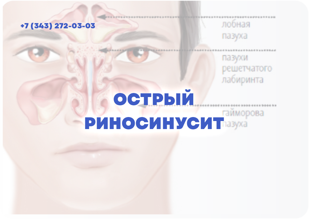 Острый риносинусит