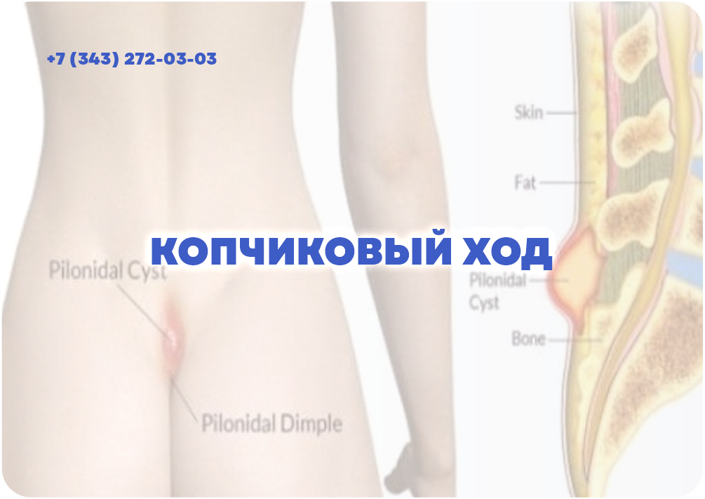 КОПЧИКОВЫЙ ХОД