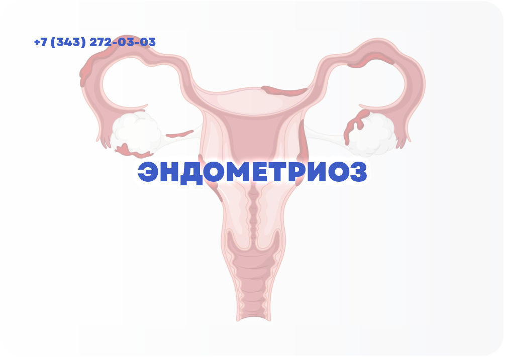 ЭНДОМЕТРИОЗ